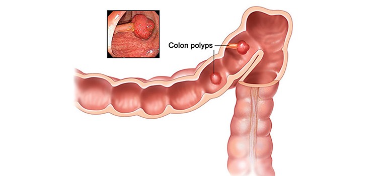 What-are-the-symptoms-of-colorectal-cancer-1-1