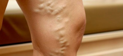 Varicose-Veins-What-Most-People-May-Not-Know