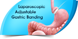 adjustable-gastric-band-off
