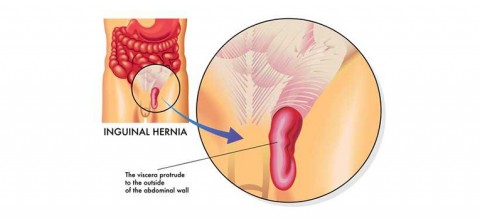 Why-Is-An-Inguinal-Hernia-More-Common-In-Men-Than-In-Women