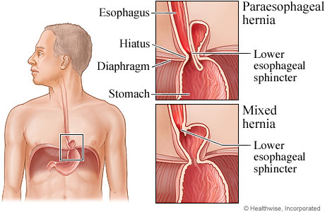 Para-esophageal-hiatal-hernias1.jpg