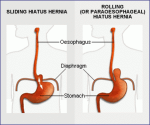 Sliding Hiatal Hernias