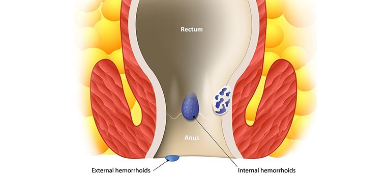 Can-piles-be-treated-without-a-surgery