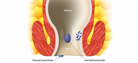 Can-piles-be-treated-without-a-surgery