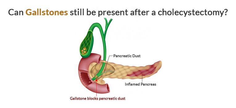 Can-Gallstones-still-be-present-after-a-cholecystectom_20171220-062640_1