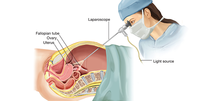 preparing for Laparoscopic Surgery