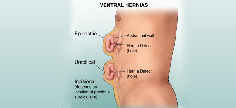 Diagnosis & Treatment of Umbilical Hernia