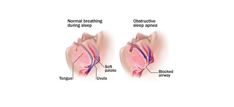 Obstructive-Sleep-Apnea-Syndrome-Symptoms-and-Treatment