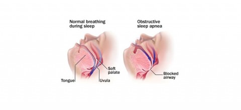 Obstructive-Sleep-Apnea-Syndrome-Symptoms-and-Treatment