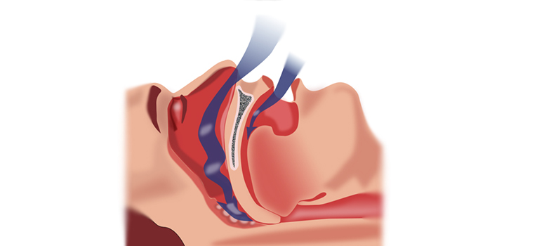 Easy Snoring Remedies: How to Stop Snoring - Neoalta Speciality Clinic