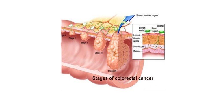 colorectal-surgery-in-Mumbai-3