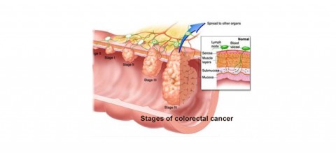 colorectal-surgery-in-Mumbai-3