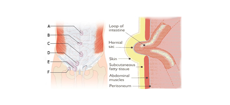 What Are The Types of Abdominal Hernias & How Do You Treat Them