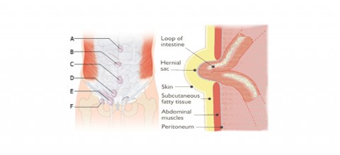 The-3-Most-Common-Types-of-Abdominal-Hernias-in-Men-1