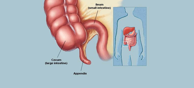 Laparoscopic-Surgery-for-Appendicitis