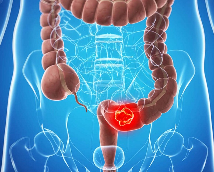 Colorectal