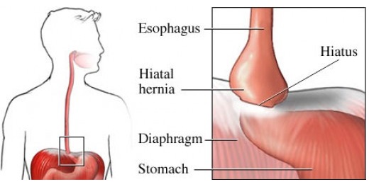 Hiatal-Hernia