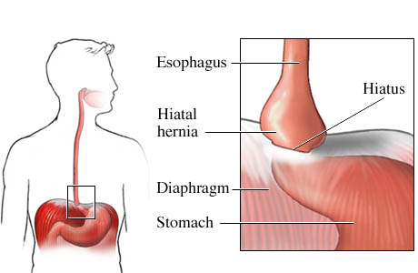 Hiatal-Hernia.jpg