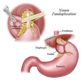 NissenFundoplication1.jpg