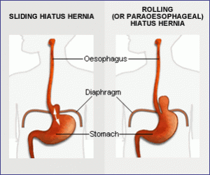 Hiatal-Hernia