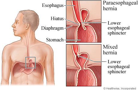 Hiatal Hernia