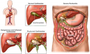 Gall Bladder Stones