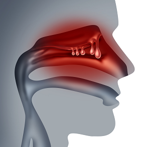 Sinusitis-Symptoms