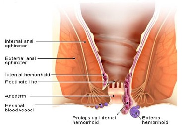 Kelina Hospital - PAINLESS PILES OPERATION Piles are also