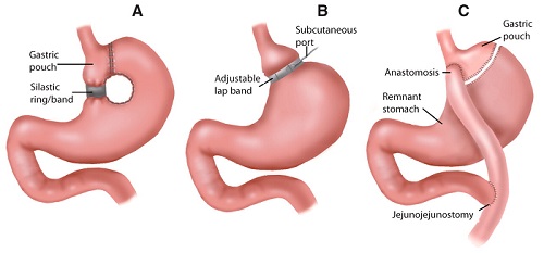 Bariatric Surgery