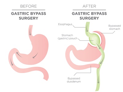 Gastric Bypass