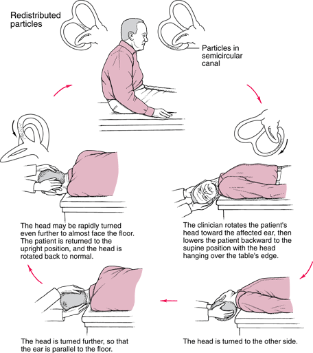 Epley Maneuver Patient Exercises 1024x1024 Epley Maneuver Patient Exercises 1024x1024